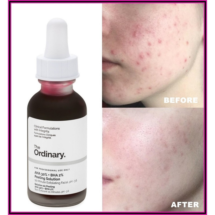 سرم لایه بردار دی اوردینری مدل AHA 30% + BHA 2% Peeling