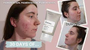 کرم ضد جوش آزلائیک اسید 10 درصد اوردینری اصل حجم 30 میل