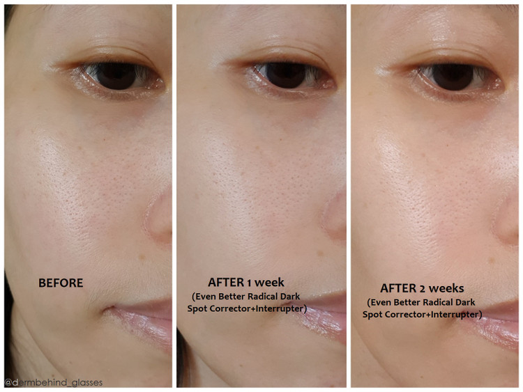 سرم ضدلک بسیار قوی ایون بتر clinique