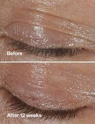 کرم ضد چروک دور چشم اسمارت کلینیک