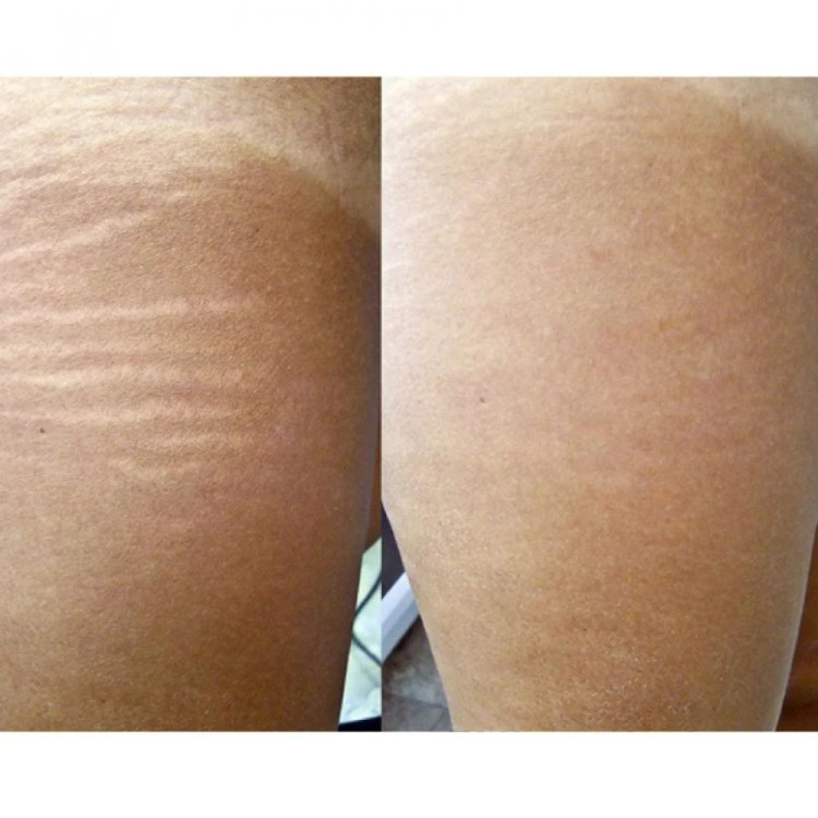 روغن ترمیم کننده پوست ( ترمیم کننده ترک های بارداری بایو اویل Bio Oil اصل