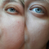 تونر ماداگاسکار سنتلا اسکین 1004 لایه بردار