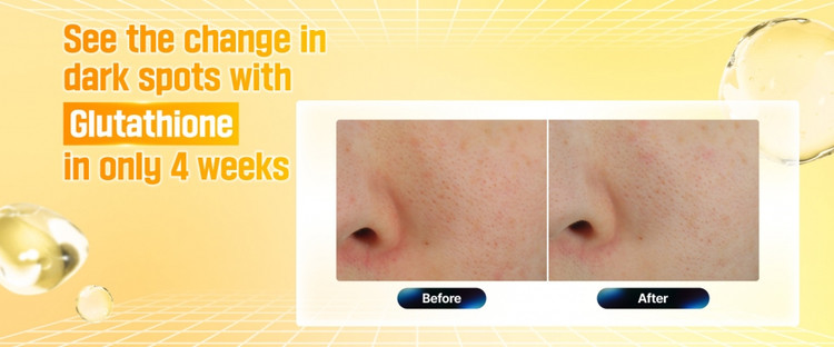 رفع لکهای تیره با کرم گلوتاتیون نامبوزین