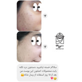 اثر سرم Reedle Shot VT Cosmetics بر درمان جای جوش و اسکار