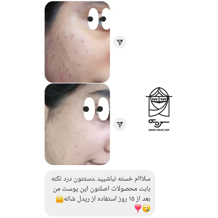 اثر سرم Reedle Shot VT Cosmetics بر درمان جای جوش و اسکار