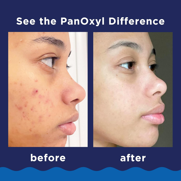 پاککننده ضدجوش PanOxyl اصل آمریکا، درمان آکنه و پیشگیری از جوش جدید پوست چرب
