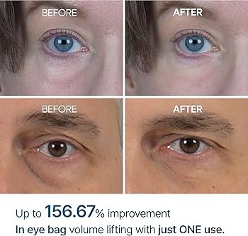 Dr.Melaxin Eyephalt Eyebag Cream کرم تخصصی کاهش پف زیر چشم با تکنولوژی Eyephalt کرهای